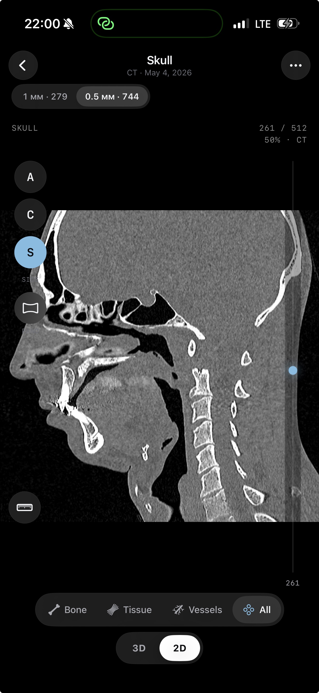 MPR sagittal slice — a side view reconstructed from axial CT slices